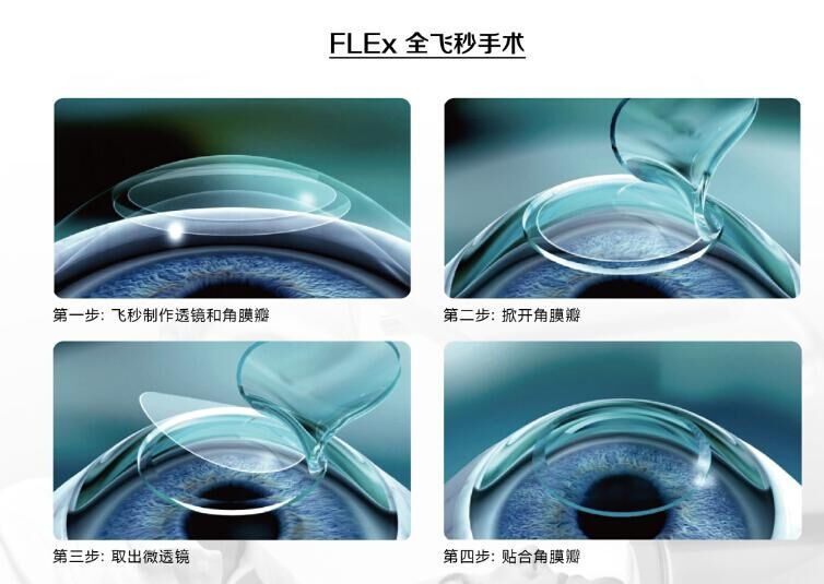 蔡司全飛秒、蔡司半飛秒近視手術(shù)與蔡司全飛秒flex手術(shù)