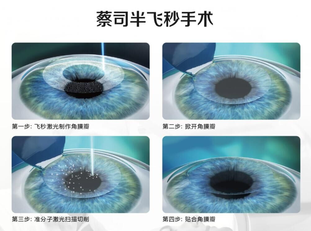 蔡司全飛秒、蔡司半飛秒近視手術(shù)與蔡司全飛秒flex手術(shù)