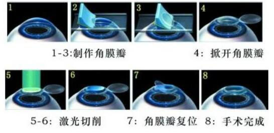 準(zhǔn)分子激光手術(shù)到底是怎么治 愈你的眼睛的？