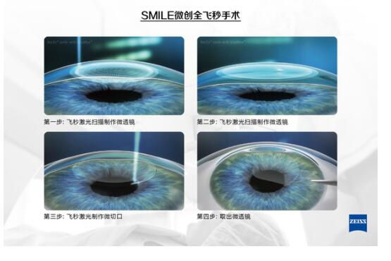 準(zhǔn)分子激光手術(shù)到底是怎么治 愈你的眼睛的？