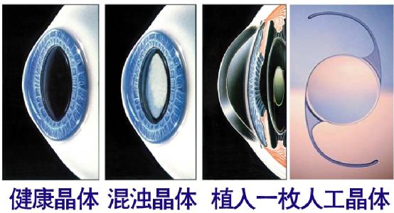 超聲乳化手術(shù)白內(nèi)障危險(xiǎn)嗎？