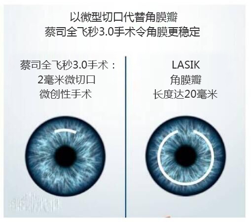 做完近視手術(shù)要休息多長時(shí)間？需要住院嗎？