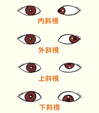 看看兒童斜視眼病怎么預(yù)防？
