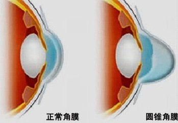 圓錐角膜，哪種角膜移植術(shù)好？