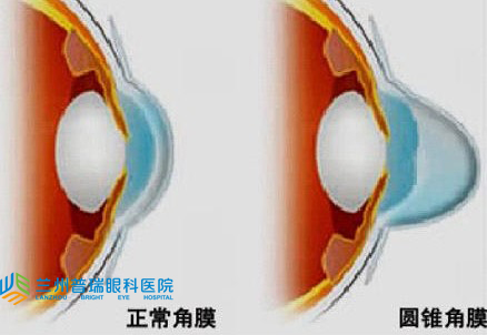 圓錐角膜怎樣？