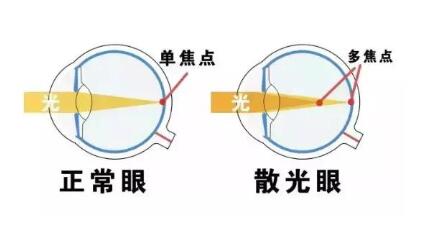近視和散光，手術(shù)能同時矯正嗎？