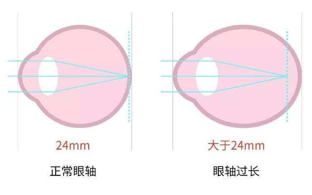 眼科醫(yī)生解密：哪些行為近視度數(shù)增長(zhǎng)快